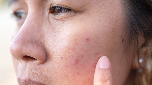 Your Guide to Clear Skin: Effective Tips to Prevent Acne