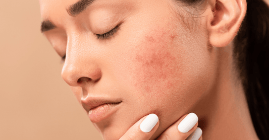 The effect of acne